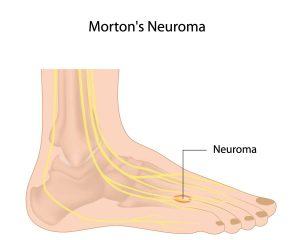 Neuromas in Yorville and Morris, IL