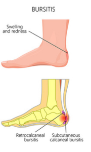 Bursitis Explained Causes Symptoms And Prevention Foot And Ankle Bursitis Explained Causes Symptoms And Prevention Foot And Ankle